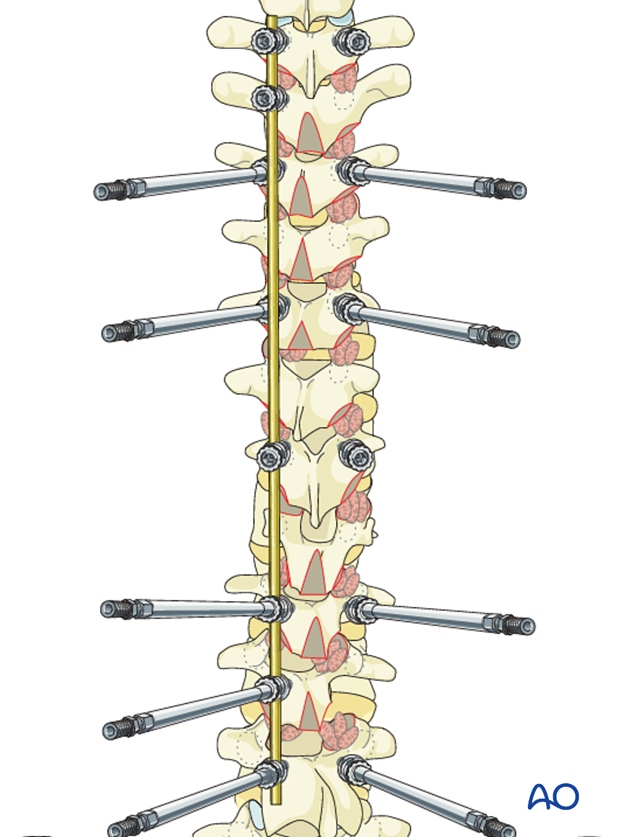 AIS Lenke 3 Posterior pedicle screws - Spine derotation