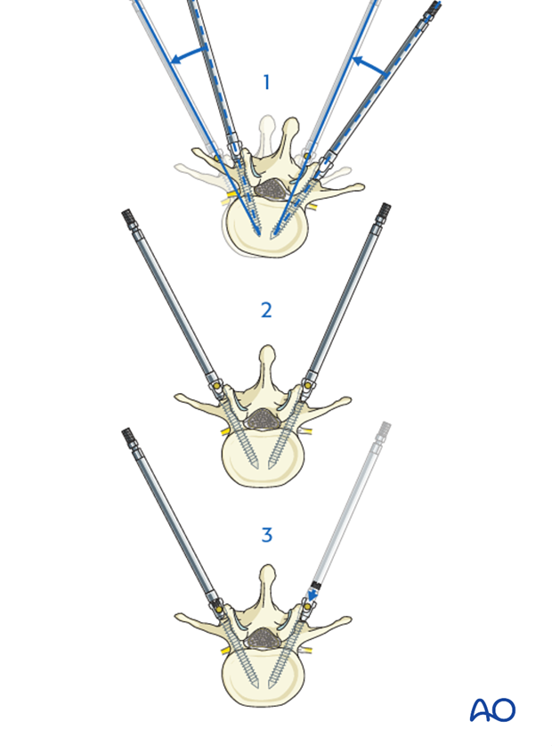 AIS Lenke 5 Posterior pedicle screws - Apical derotation
