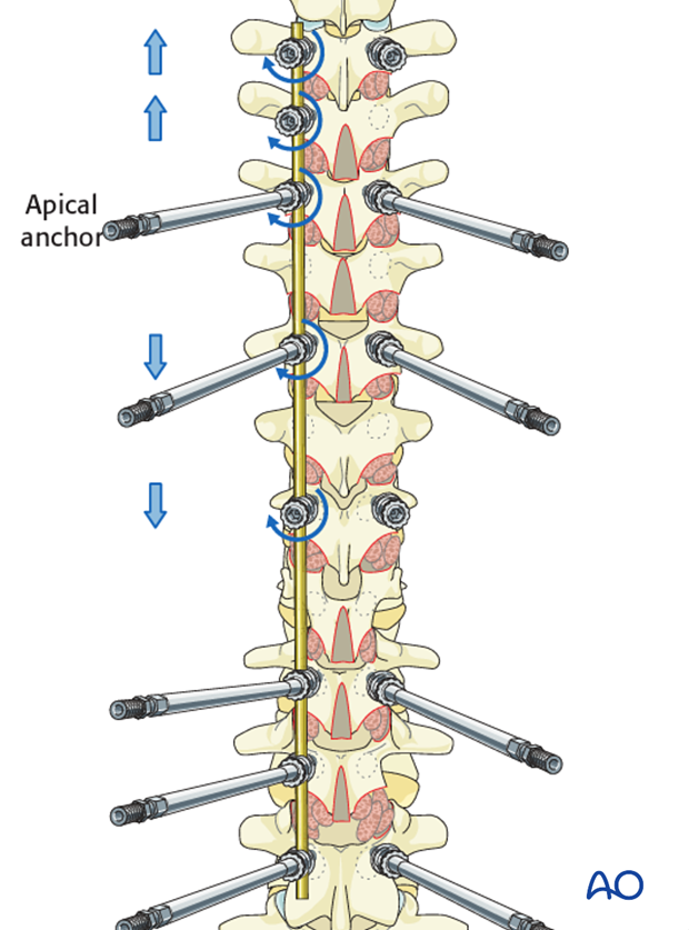 AIS Lenke 3 Posterior pedicle screws - Distraction