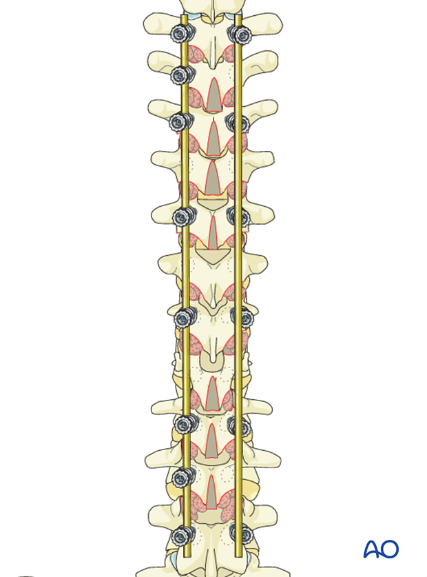 AIS Lenke 3 Posterior pedicle screws - Rod insertion