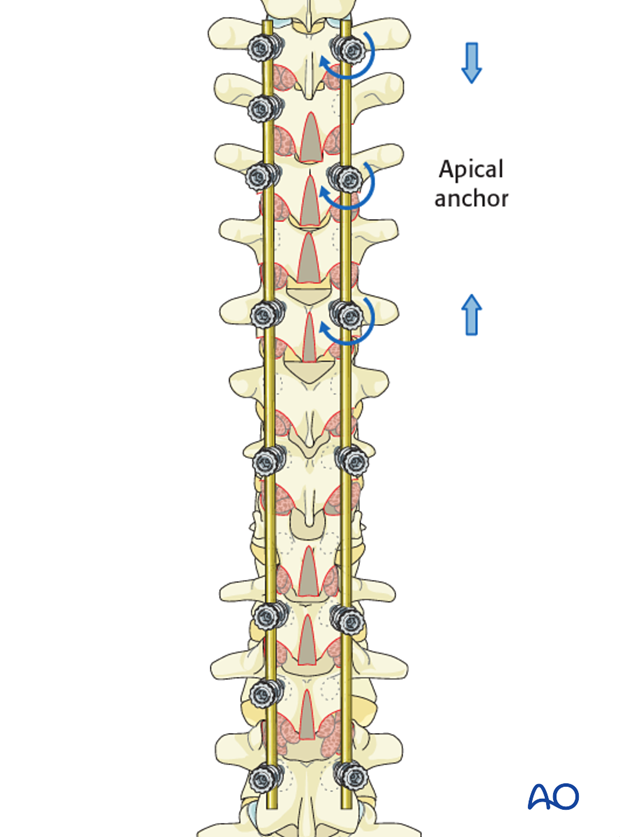 AIS Lenke 3 Posterior pedicle screws - Compression