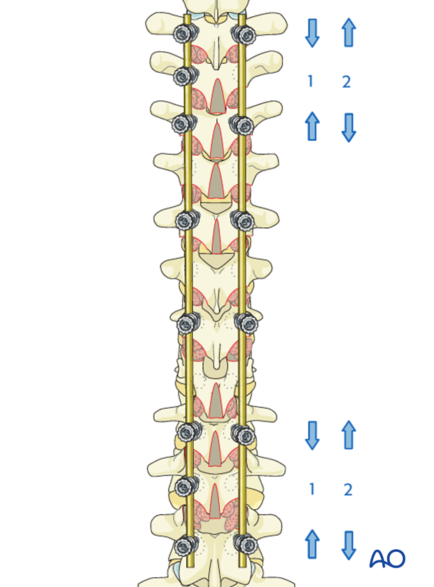 AIS Lenke 3 Posterior pedicle screws - Fine tuning