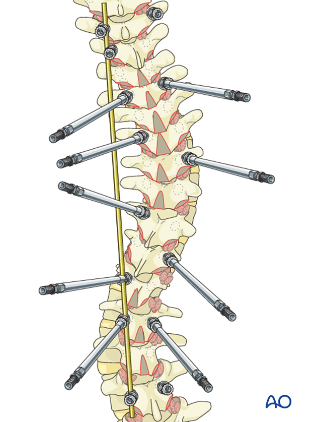AIS Lenke 4 Posterior pedicle screws - Derotation of the spine