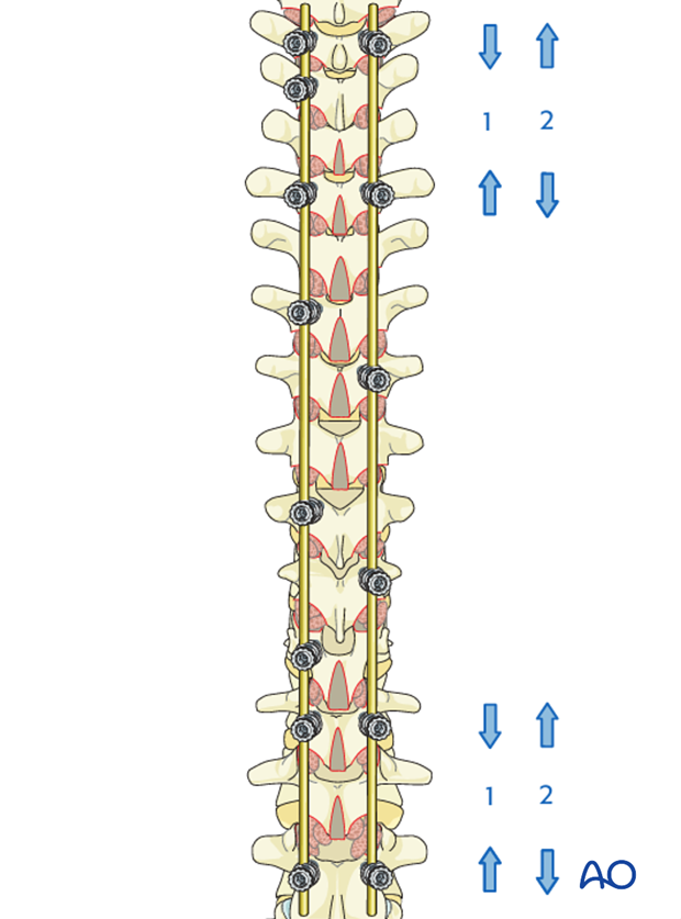 posterior screws with direct vertebral body derotation