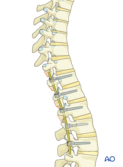 Posterior Screws - With direct vertebral body derotation for Lenke 5