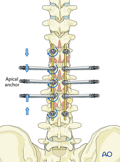 Posterior Screws - With direct vertebral body derotation for Lenke 5