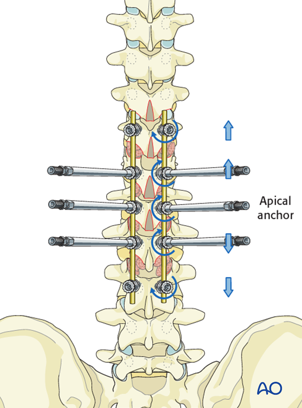 AIS Lenke 5 Posterior pedicle screws - Distraction