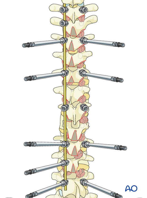 AIS Lenke 6 Posterior pedicle screws - Derotation of the spine
