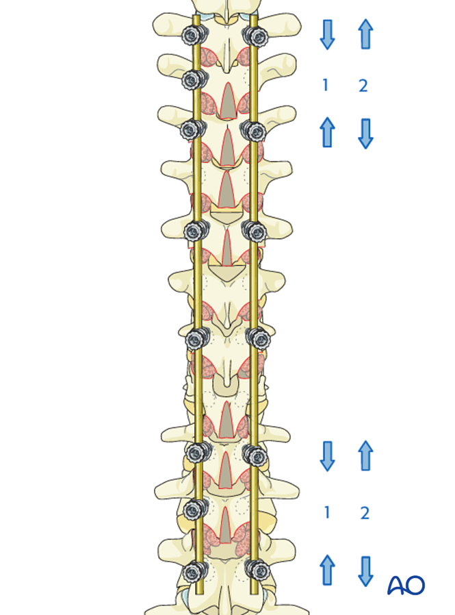 Posterior Screws - With direct vertebral body derotation for Lenke 6