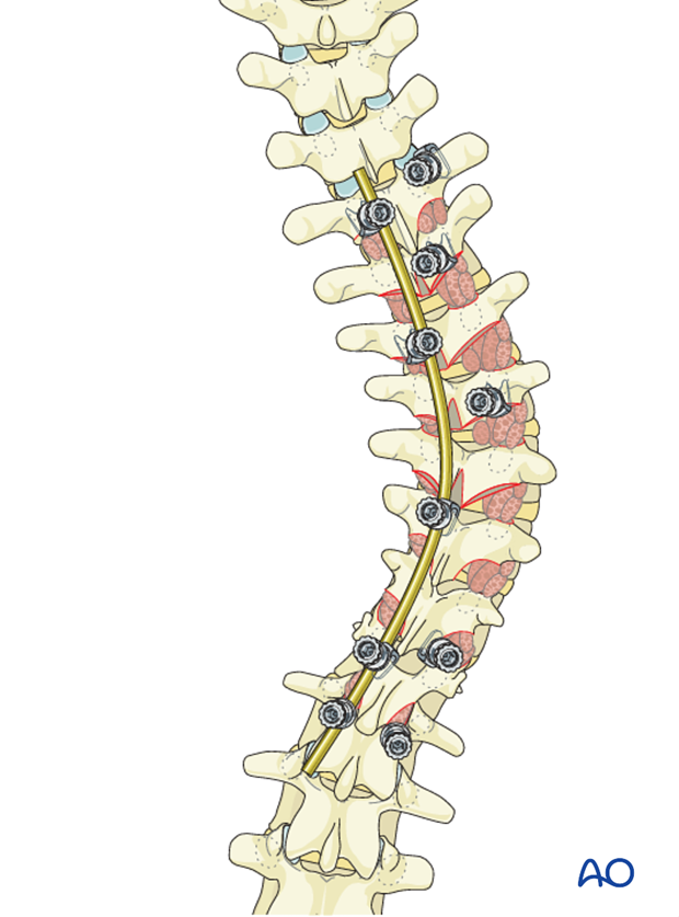 AIS Lenke 1 Posterior surgery - Rod insertion