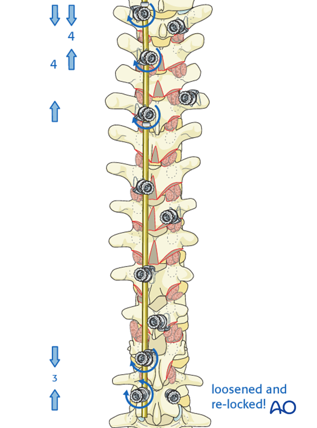 AIS Lenke 2 Posterior surgery - Compression and distraction