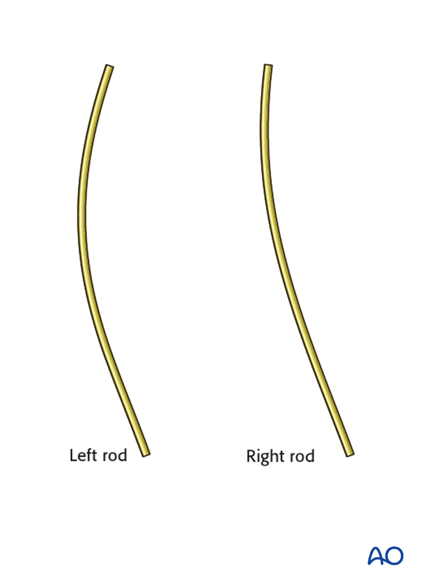AIS Lenke 2 Posterior surgery - Rod bending