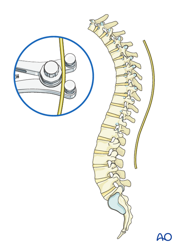 AIS Lenke 3 Posterior surgery - Rod bending