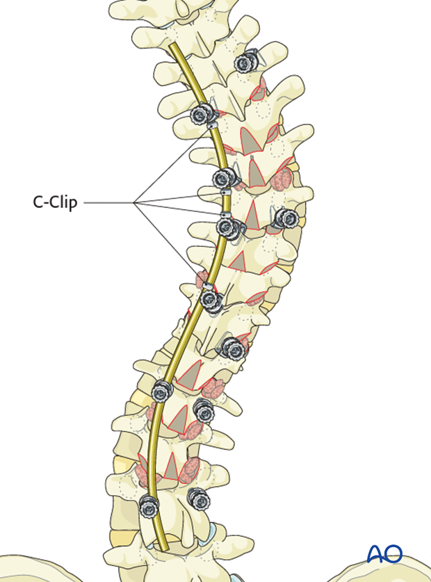 AIS Lenke 3 Posterior surgery - Rod insertion