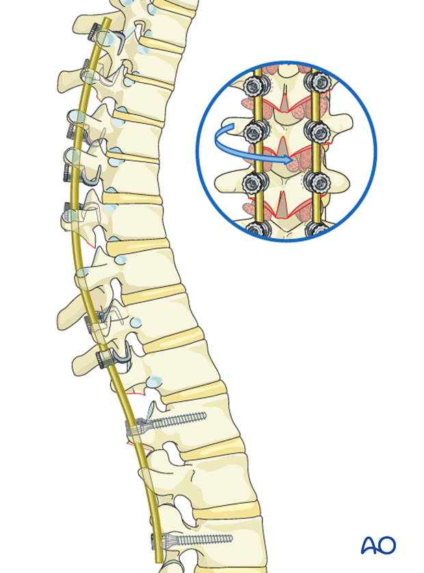 AIS Lenke 3 Posterior surgery - Correction of deformity