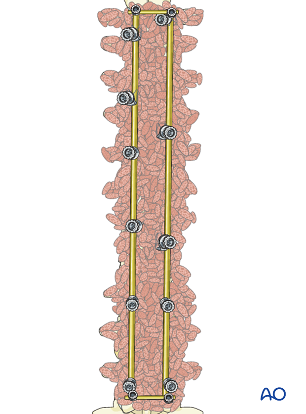 AIS Lenke 3 Posterior surgery - Transverse rod connectors