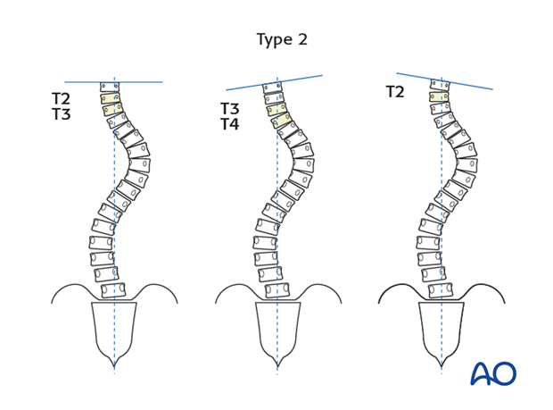 selection of fusion level