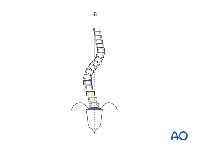 Selection of fusion level