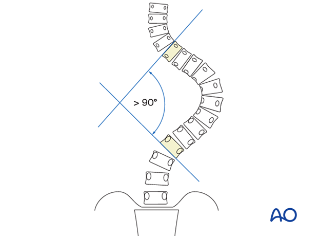 Large curves in adolescent idiopathic scoliosis