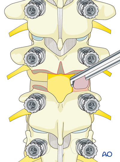 Posterior Screws - With direct vertebral body derotation for Lenke 6