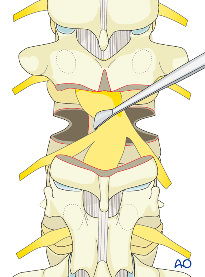 Management of large curves in the spine