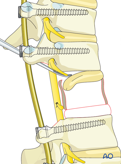 Management of large curves in the spine