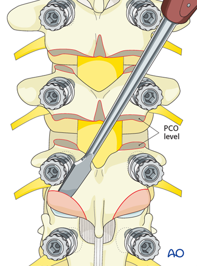 Posterior Screws - With direct vertebral body derotation for Lenke 6