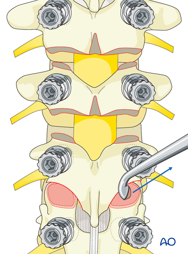 AIS Lenke 1 Posterior pedicle screws - Facet joint fusion
