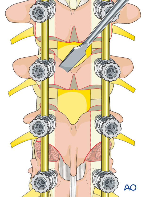 AIS Lenke 1 Posterior pedicle screws - Decortication