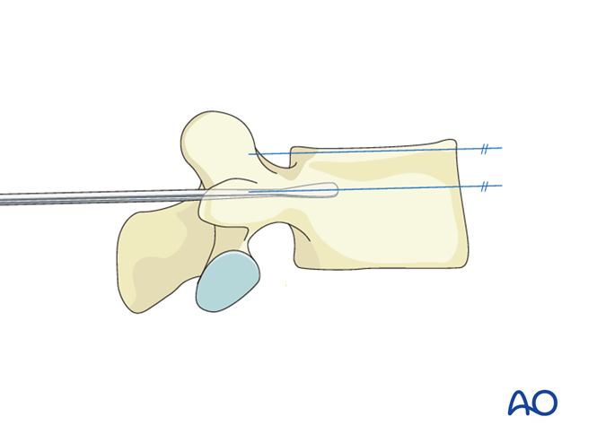 Insertion of pedicle screws