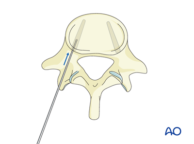 Insertion Of Pedicle Screws