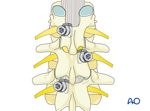 Hook insertion for management of adolescent idiopathic scoliosis