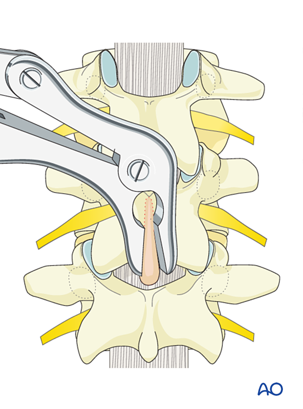 Spinous process removal for sublaminar wire insertion