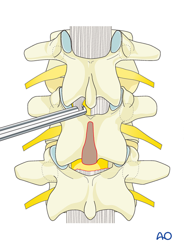 Removal of ligamentum flavum for sublaminar wire insertion