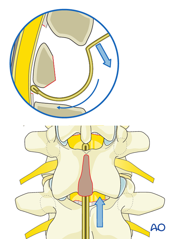 Passing the sublaminar wire under the inferior laminar surface