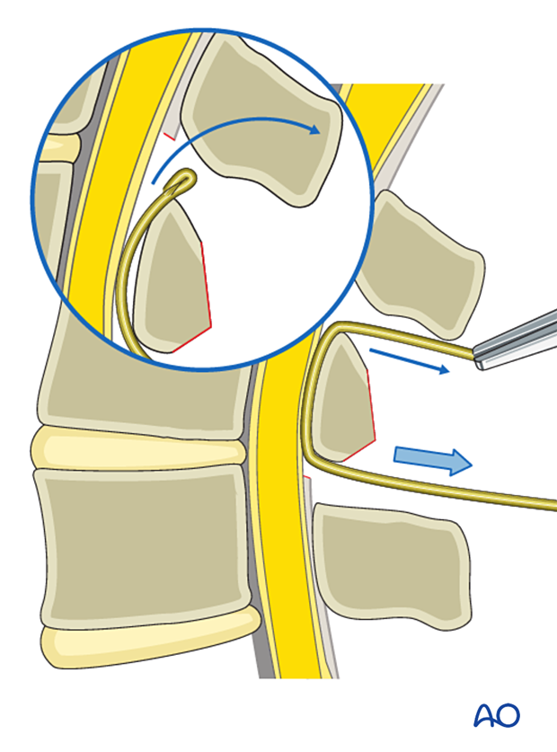 Pulling the leading edge of the wire during insertion of a sublaminar wire