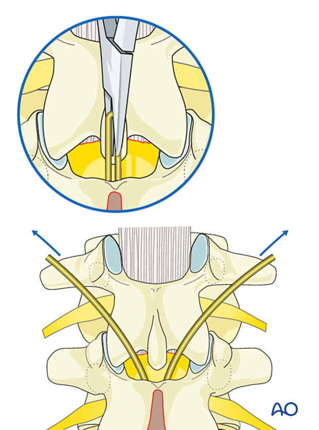 Cutting the tip of the sublaminar wire after insertion