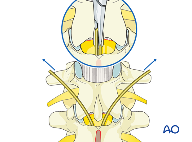 Cutting the tip of the sublaminar wire after insertion