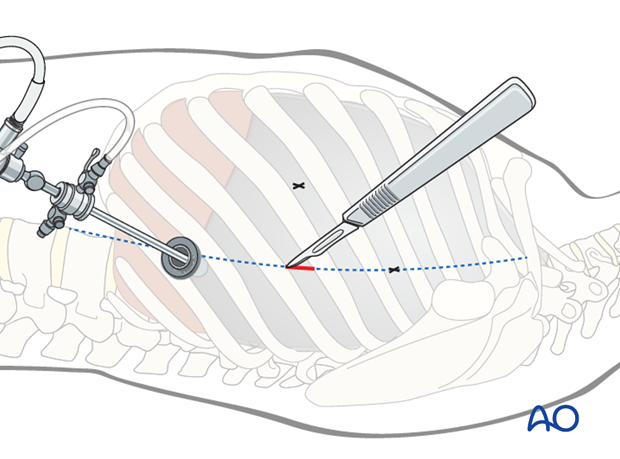 anterior thoracoscopic release