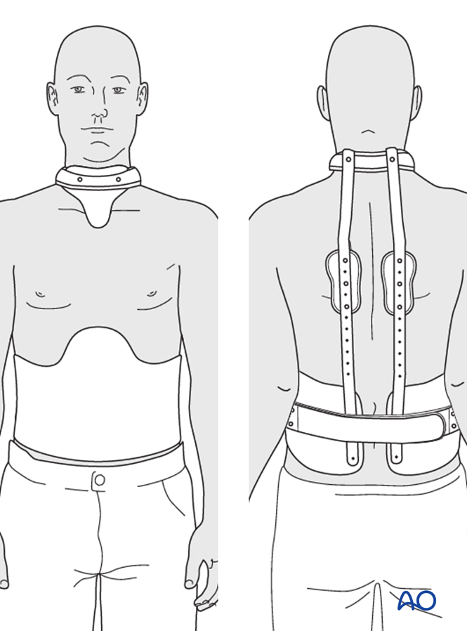 Nonoperative procedure for Scheuermann's Kyphosis