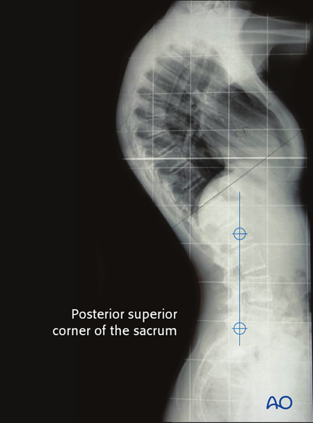 posterior instrumentation without release