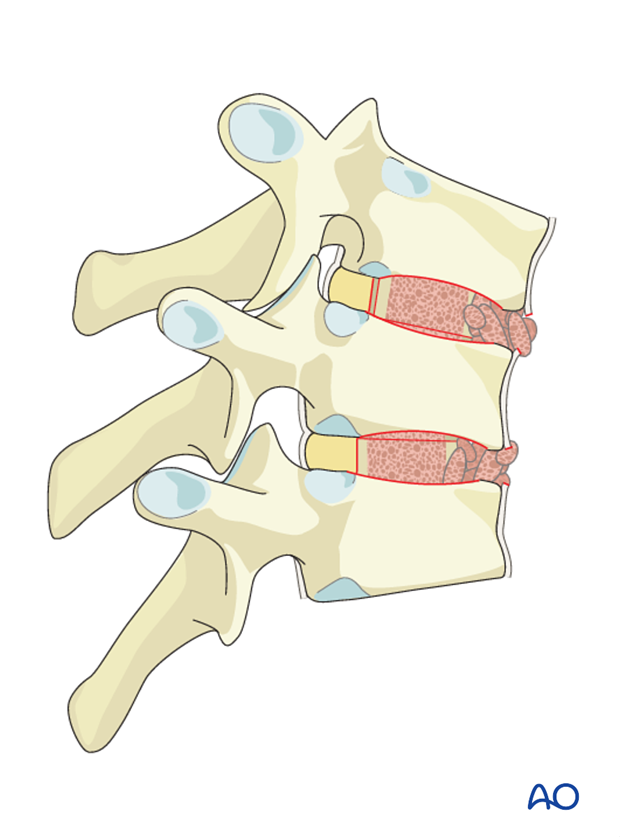 posterior instrumentation with release