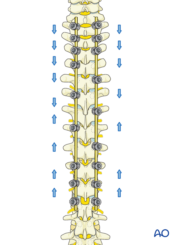 posterior instrumentation without release