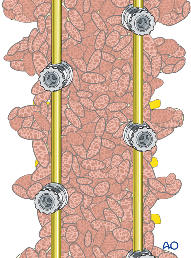 posterior instrumentation without release