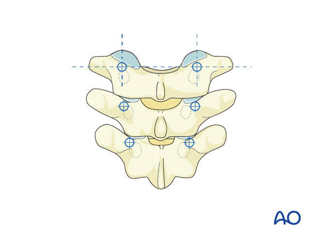 Pedicle screw insertion in the thoracic spine