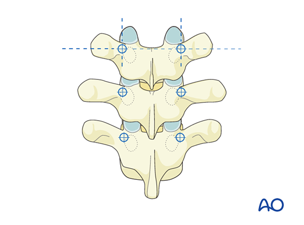 Entry point is cranial and medial; intersects upper 1/3 transverse process and center articular facet.