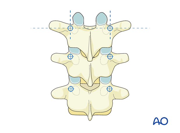 Entry point is cranial and medial; intersects top of transverse process and medial articular facet line.