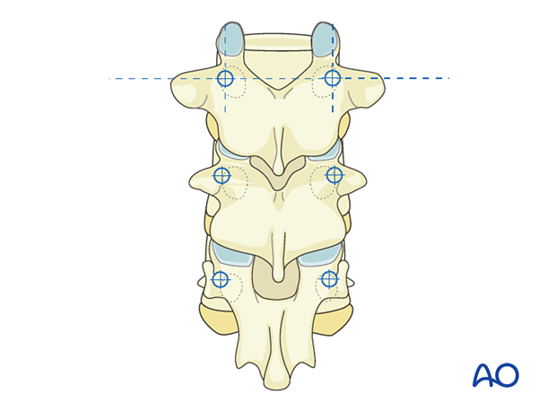 Entry at mammillary process or upper 1/3 transverse process and center of articular facet; narrow pedicles.