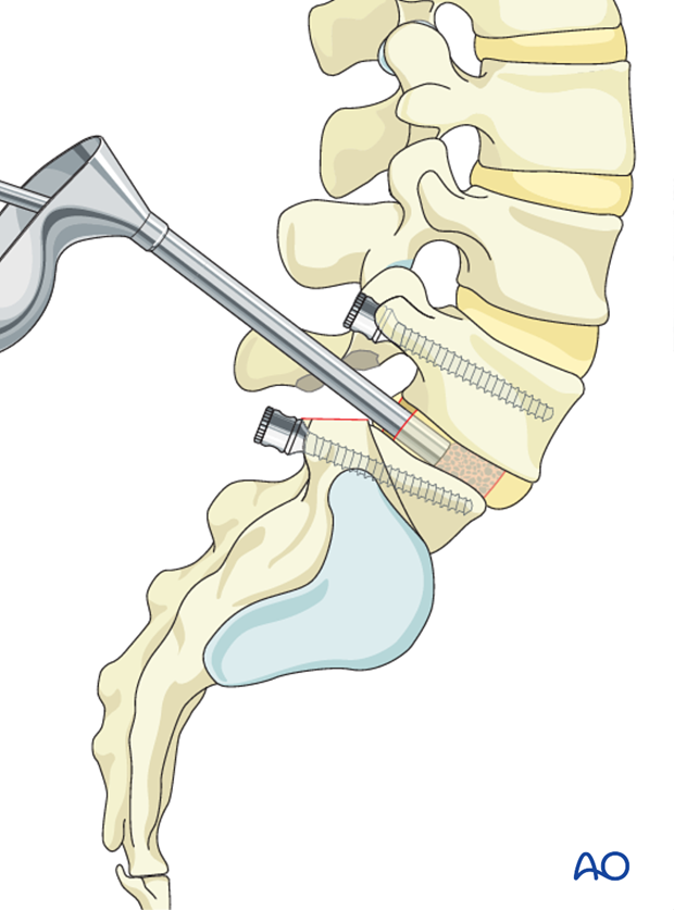 posterior fusion l5 s1
