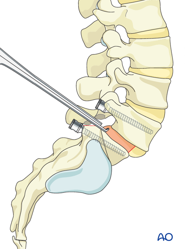 posterior fusion of l5 s1